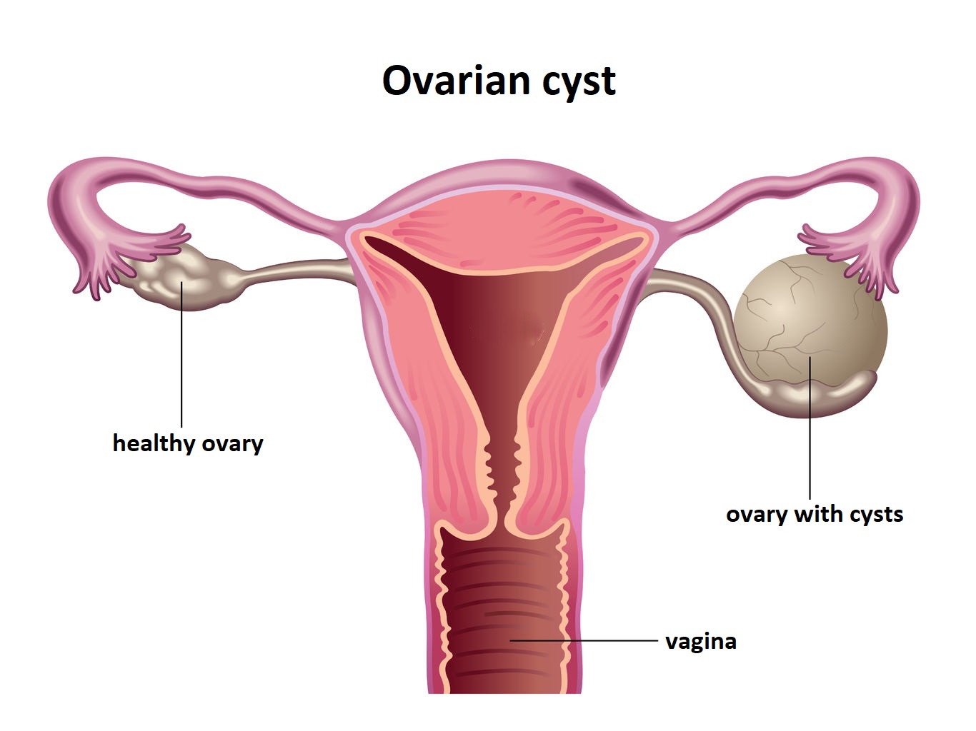 Targeting Key Opinion Leaders in Ovarian Cancer Research | DLI
