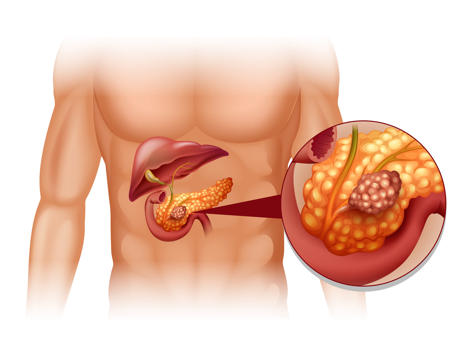 Revolutionize Pancreatic Cancer Care: Insights into Pricing and Reimbursement
