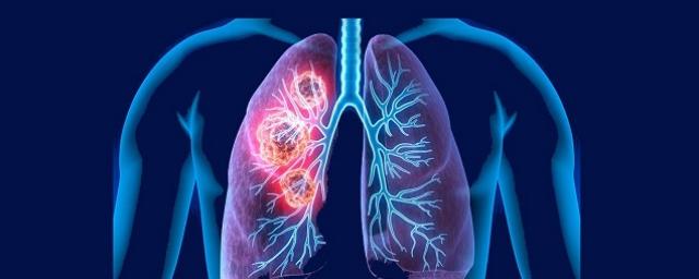 Unraveling the Pneumonia Epidemic: Insights and Epidemiology | DLI
