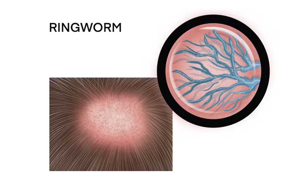 Empowering Patients: Ringworm Treatment Consulting Services | DLI