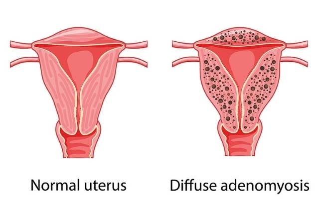 Strategic Solutions: Overcoming Adenomyosis Challenges at DLI