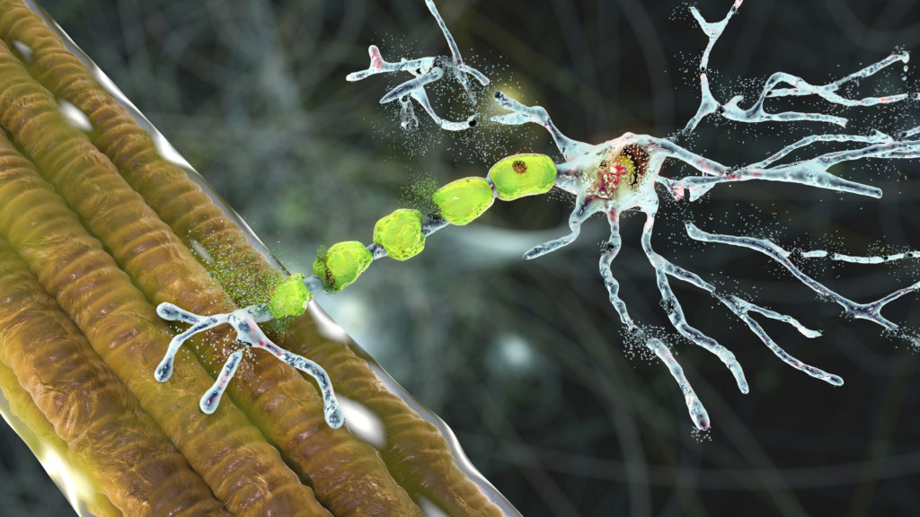 Amyotrophic Lateral Sclerosis Pharma Consulting: A Rare Challenge Demands Expertise In Regulatory Affairs And Market Access| DLI