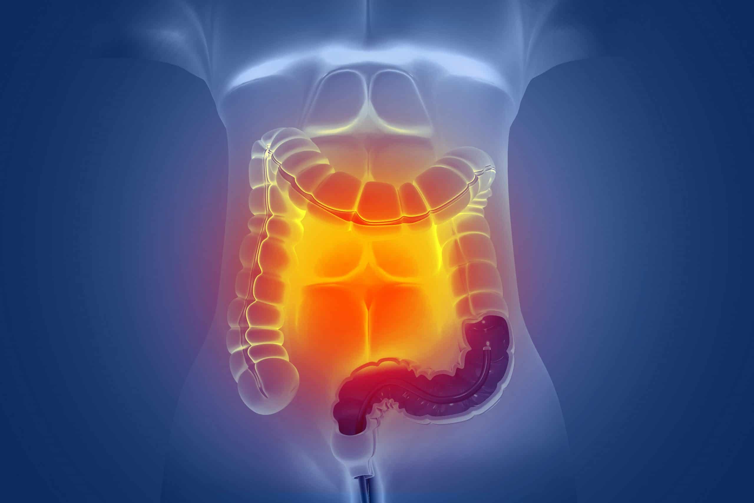 Colorectal Cancer Market Entry: A Path to Regulatory and Commercial Success | DLI