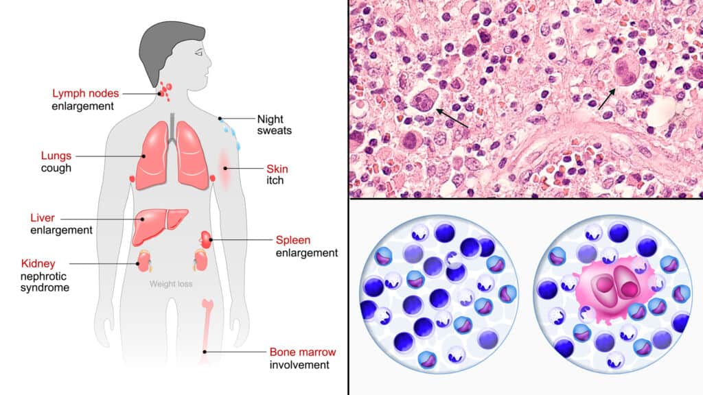 Epidemiology Study: Illuminating Trends in Lymphoma Incidence and Prevalence | DLI