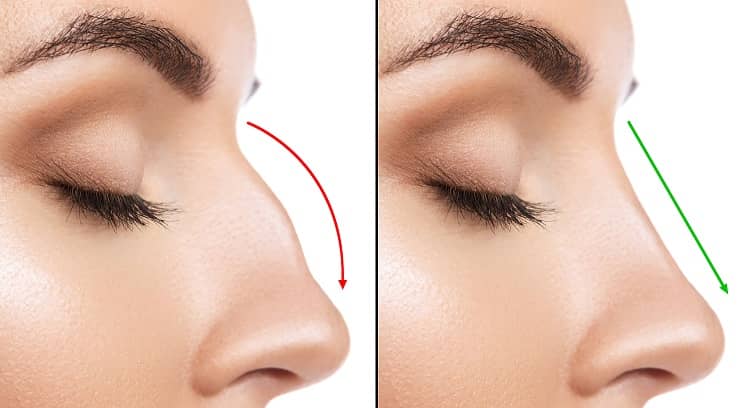 Dubai Dreams: Crafting the Perfect Nose with Rhinoplasty Magic